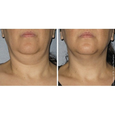 Ultherapy Prime - The Non-Surgical Face Lift